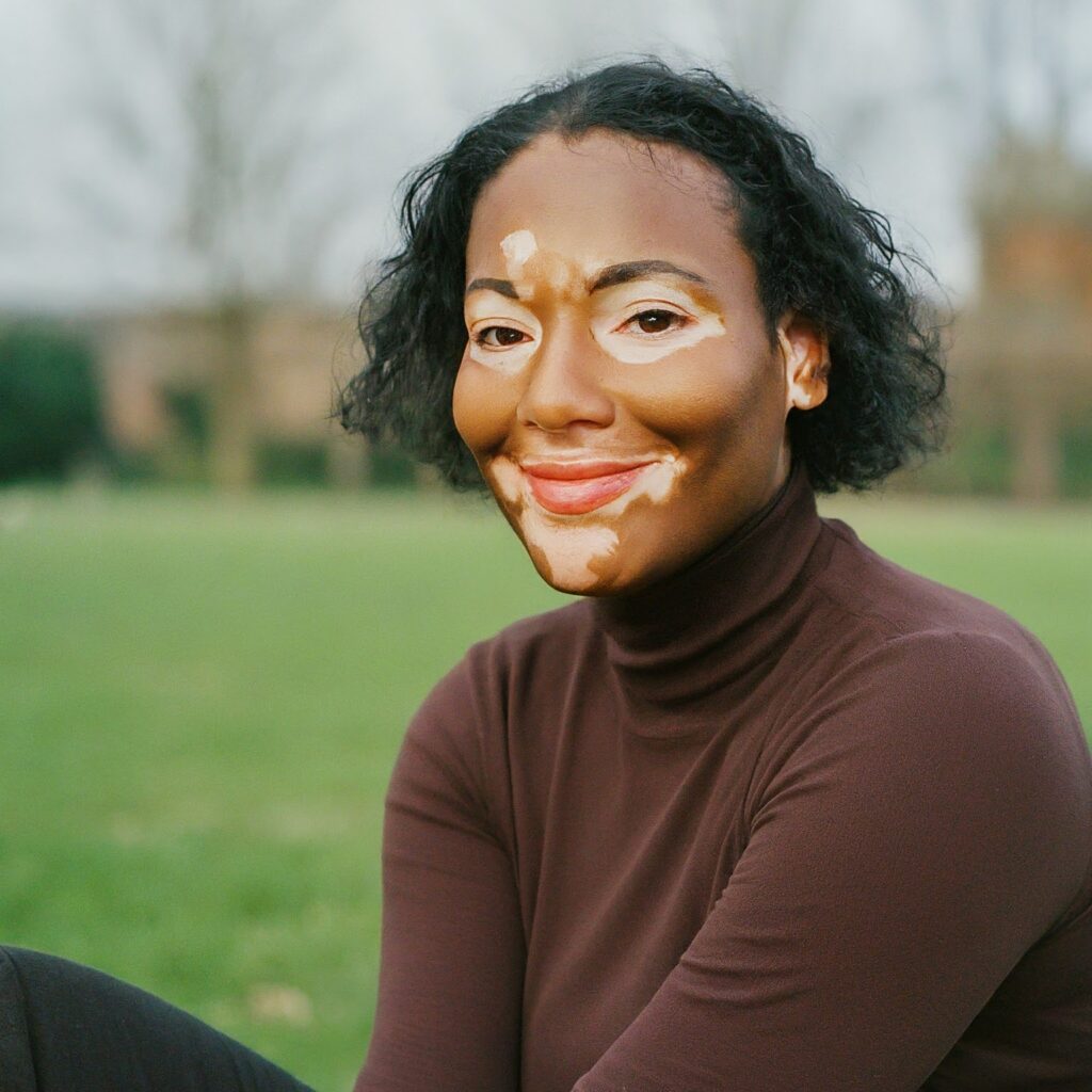 Vitiligo y Autoestima: Consejos para Mejorar la Confianza Vitiligo y Autoestima: Consejos para Mejorar la Confianza 12